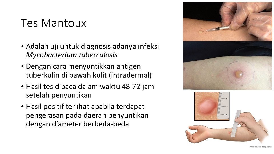 Tes Mantoux • Adalah uji untuk diagnosis adanya infeksi Mycobacterium tuberculosis • Dengan cara