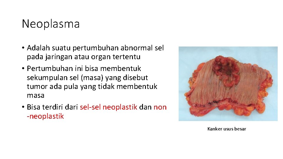 Neoplasma • Adalah suatu pertumbuhan abnormal sel pada jaringan atau organ tertentu • Pertumbuhan