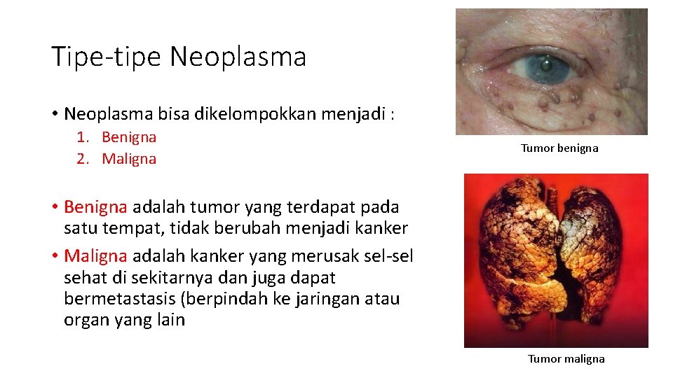 Tipe-tipe Neoplasma • Neoplasma bisa dikelompokkan menjadi : 1. Benigna 2. Maligna Tumor benigna