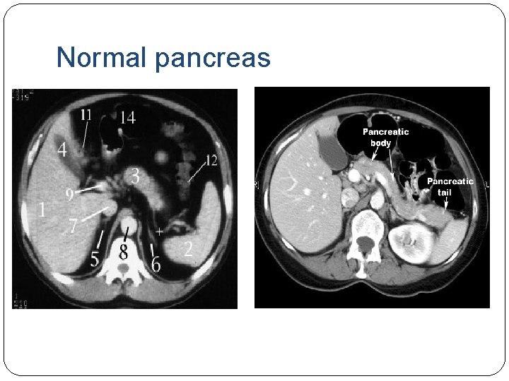 Normal pancreas 