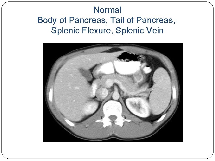 Normal Body of Pancreas, Tail of Pancreas, Splenic Flexure, Splenic Vein 