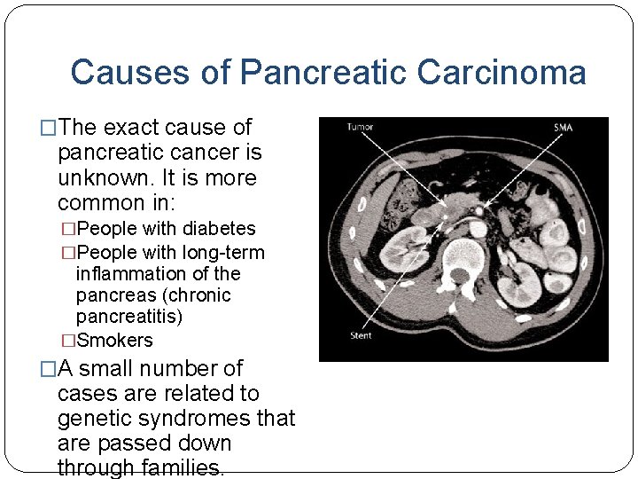 Causes of Pancreatic Carcinoma �The exact cause of pancreatic cancer is unknown. It is