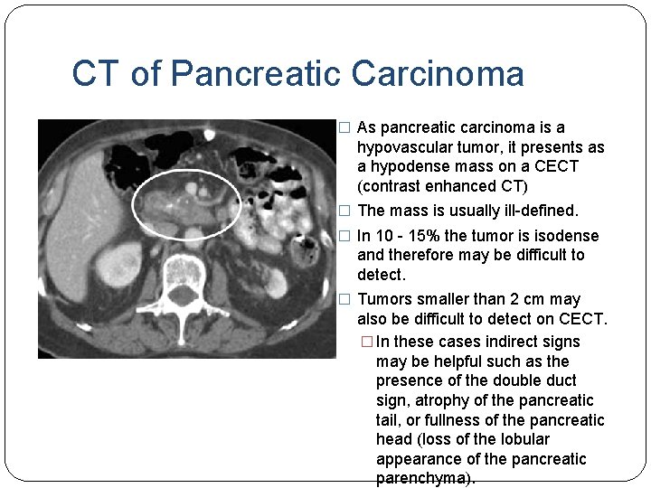 CT of Pancreatic Carcinoma � As pancreatic carcinoma is a hypovascular tumor, it presents