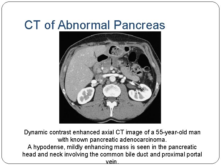 CT of Abnormal Pancreas Dynamic contrast enhanced axial CT image of a 55 -year-old