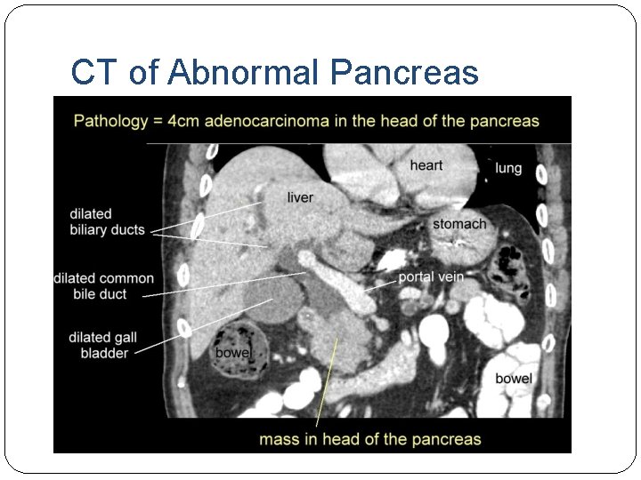 CT of Abnormal Pancreas 
