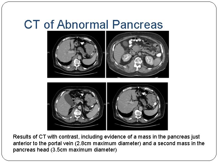 CT of Abnormal Pancreas Results of CT with contrast, including evidence of a mass