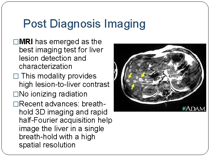 Post Diagnosis Imaging �MRI has emerged as the best imaging test for liver lesion