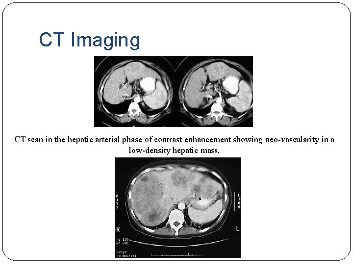 CT Imaging CT scan in the hepatic arterial phase of contrast enhancement showing neo-vascularity