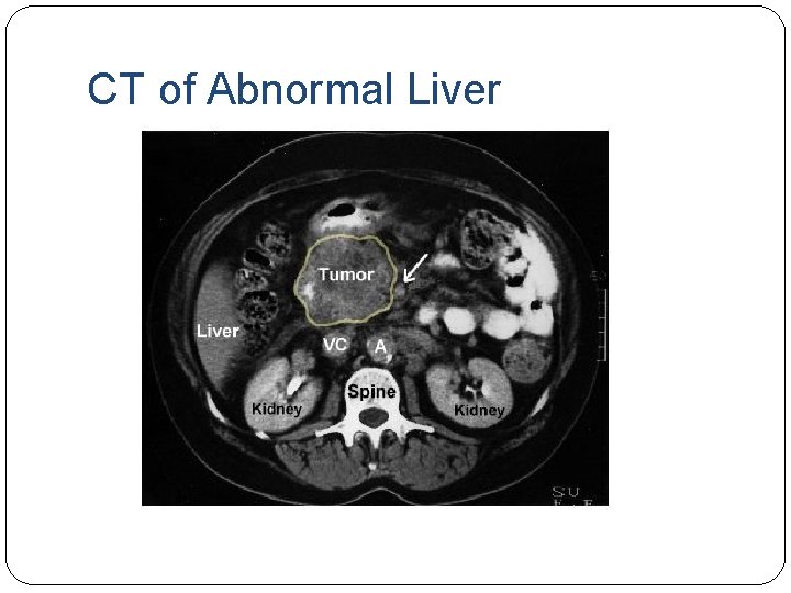 CT of Abnormal Liver 