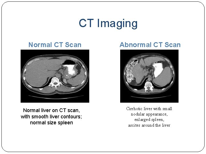 CT Imaging Normal CT Scan Normal liver on CT scan, with smooth liver contours;
