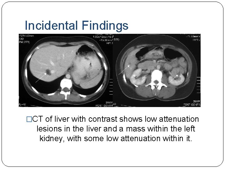 Incidental Findings �CT of liver with contrast shows low attenuation lesions in the liver