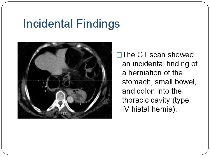 Incidental Findings �The CT scan showed an incidental finding of a herniation of the