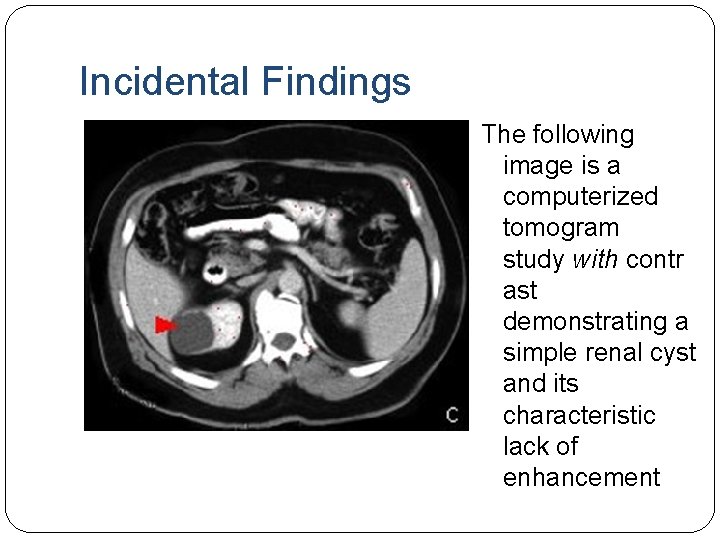 Incidental Findings The following image is a computerized tomogram study with contr ast demonstrating