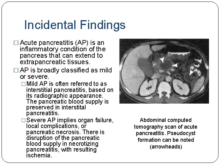 Incidental Findings � Acute pancreatitis (AP) is an inflammatory condition of the pancreas that