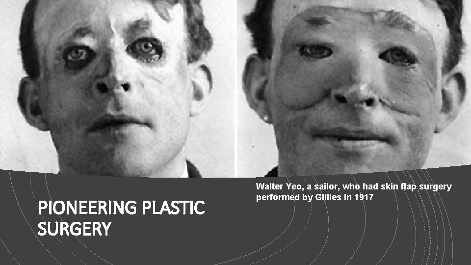 PIONEERING PLASTIC SURGERY Walter Yeo, a sailor, who had skin flap surgery performed by