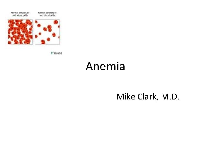 Anemia Mike Clark, M. D. Anemia Mike Clark, M. D.