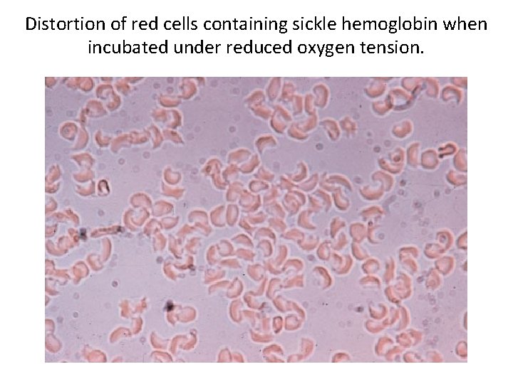 Distortion of red cells containing sickle hemoglobin when incubated under reduced oxygen tension. 