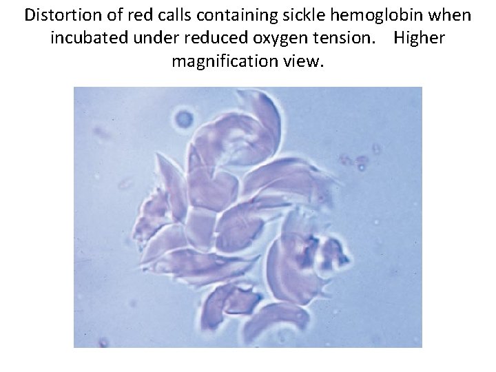 Distortion of red calls containing sickle hemoglobin when incubated under reduced oxygen tension. Higher