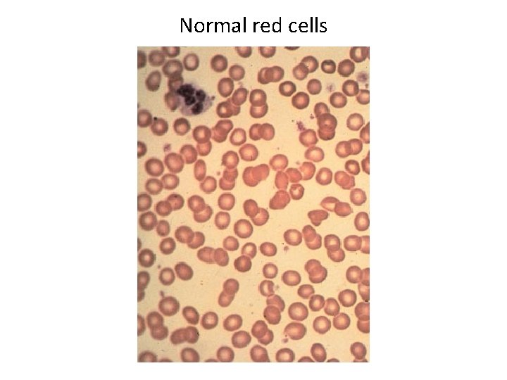 Normal red cells 