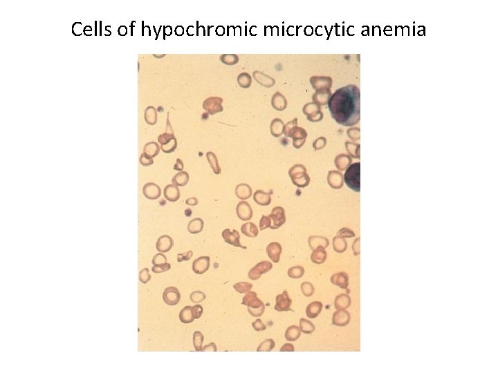 Cells of hypochromic microcytic anemia 