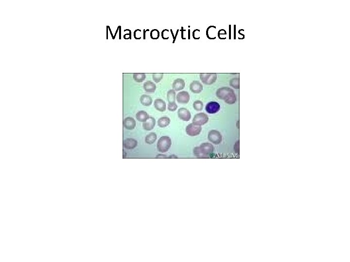 Macrocytic Cells 