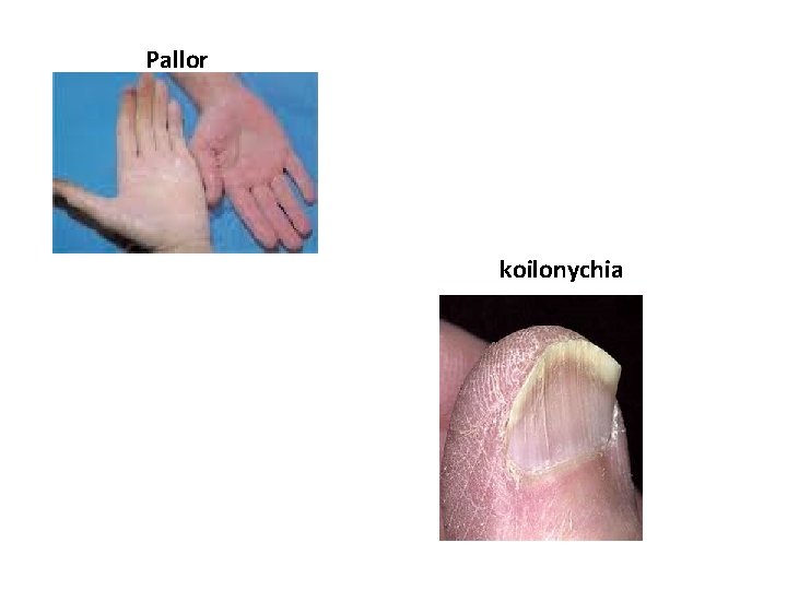 Pallor koilonychia 