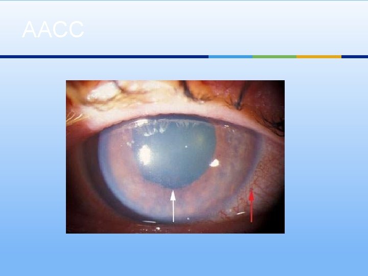 AACC 