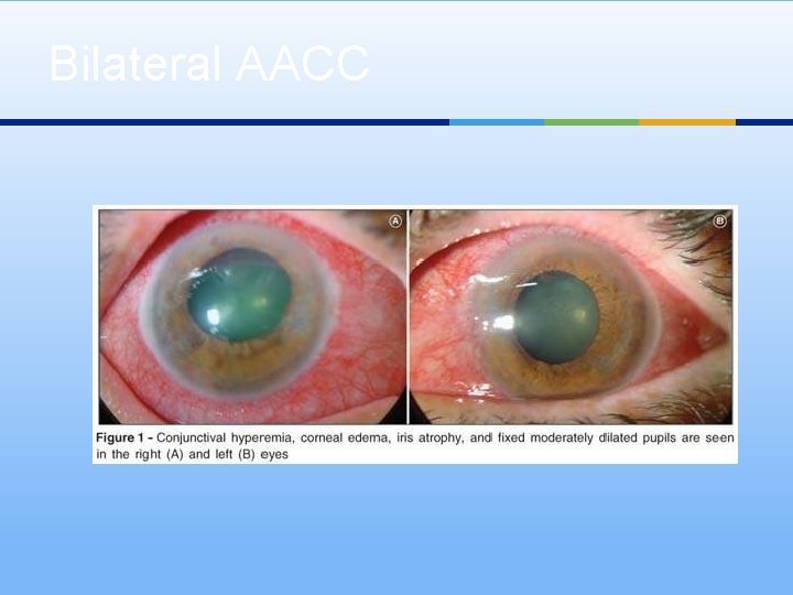 Bilateral AACC 