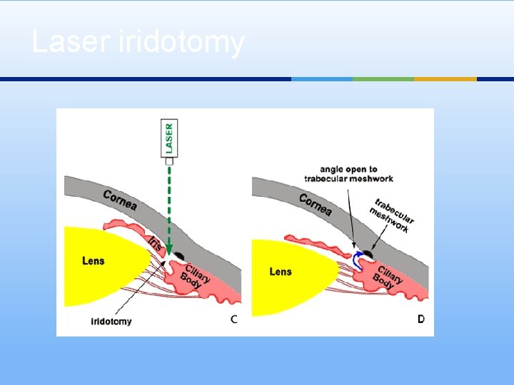 Laser iridotomy 