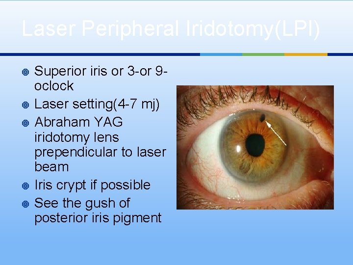 Laser Peripheral Iridotomy(LPI) ¥ ¥ ¥ Superior iris or 3 -or 9 oclock Laser