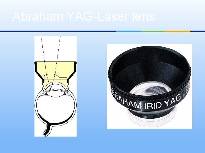 Abraham YAG-Laser lens 
