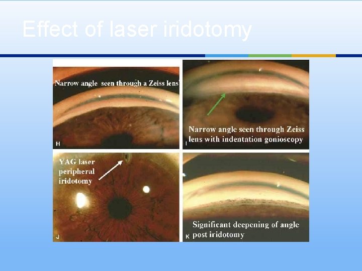 Effect of laser iridotomy 