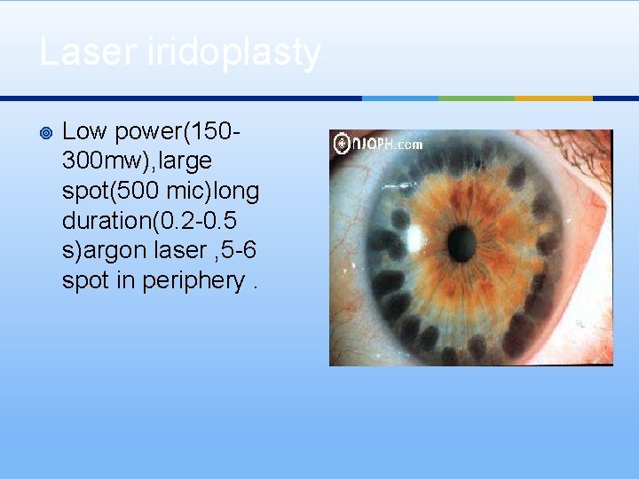 Laser iridoplasty ¥ Low power(150300 mw), large spot(500 mic)long duration(0. 2 -0. 5 s)argon