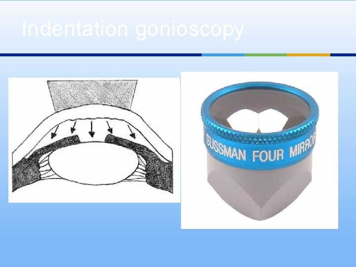Indentation gonioscopy 