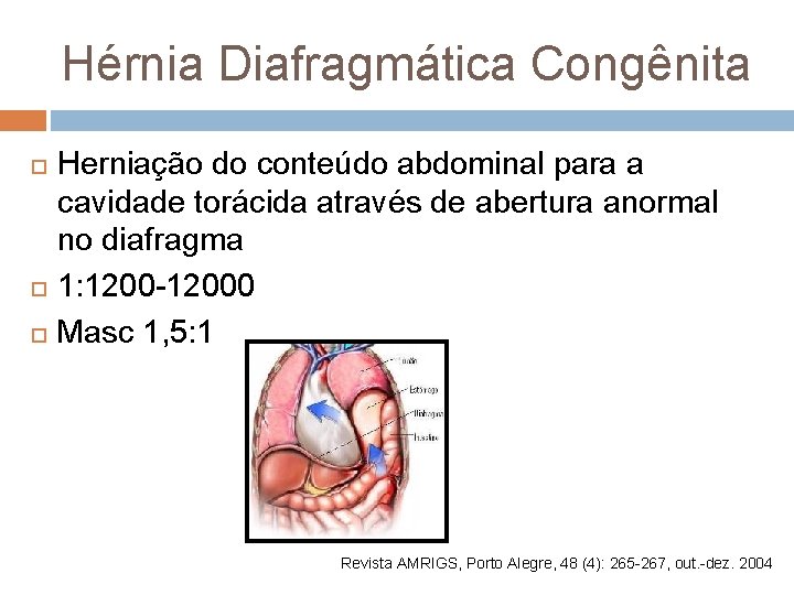 Hérnia Diafragmática Congênita Herniação do conteúdo abdominal para a cavidade torácida através de abertura