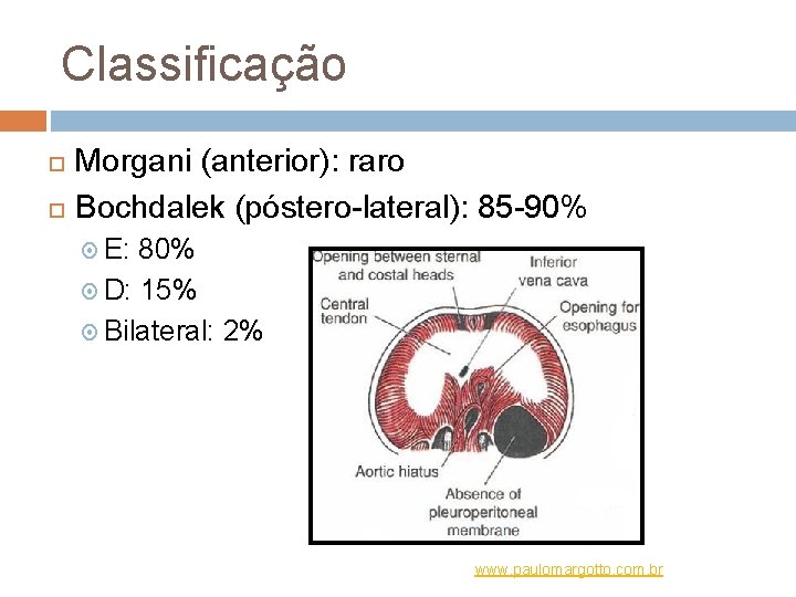 Classificação Morgani (anterior): raro Bochdalek (póstero-lateral): 85 -90% E: 80% D: 15% Bilateral: 2%