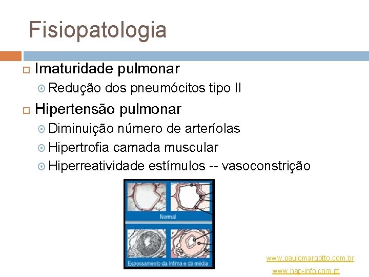 Fisiopatologia Imaturidade pulmonar Redução dos pneumócitos tipo II Hipertensão pulmonar Diminuição número de arteríolas