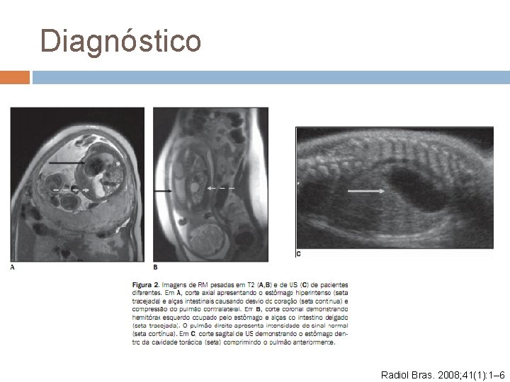 Diagnóstico Radiol Bras. 2008; 41(1): 1– 6 