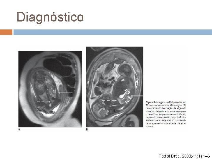 Diagnóstico Radiol Bras. 2008; 41(1): 1– 6 