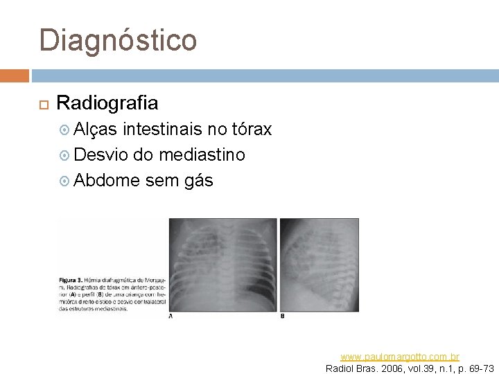 Diagnóstico Radiografia Alças intestinais no tórax Desvio do mediastino Abdome sem gás www. paulomargotto.
