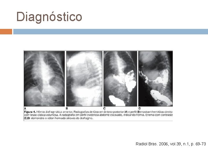 Diagnóstico Radiol Bras. 2006, vol. 39, n. 1, p. 69 -73 