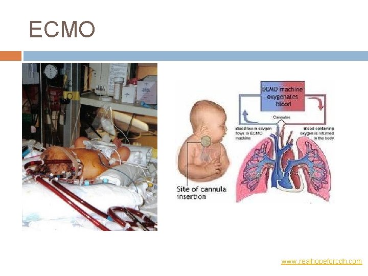 ECMO www. realhopeforcdh. com 