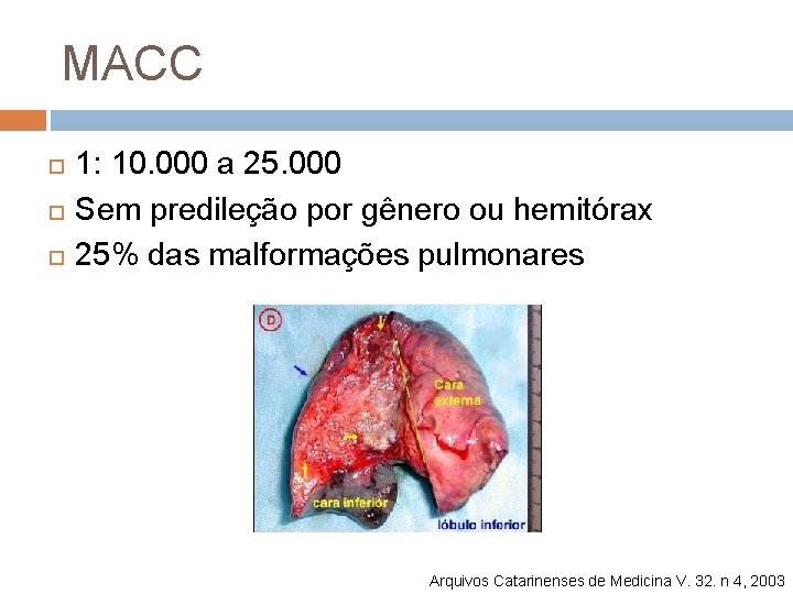 MACC 1: 10. 000 a 25. 000 Sem predileção por gênero ou hemitórax 25%