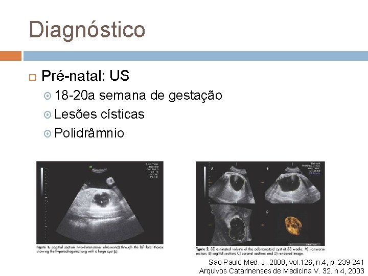 Diagnóstico Pré-natal: US 18 -20 a semana de gestação Lesões císticas Polidrâmnio Sao Paulo