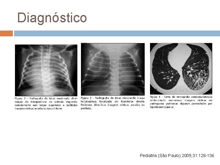 Diagnóstico Pediatria (São Paulo) 2009; 31: 128 -136 