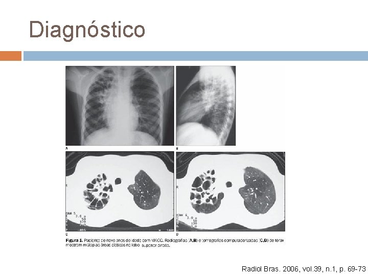 Diagnóstico Radiol Bras. 2006, vol. 39, n. 1, p. 69 -73 