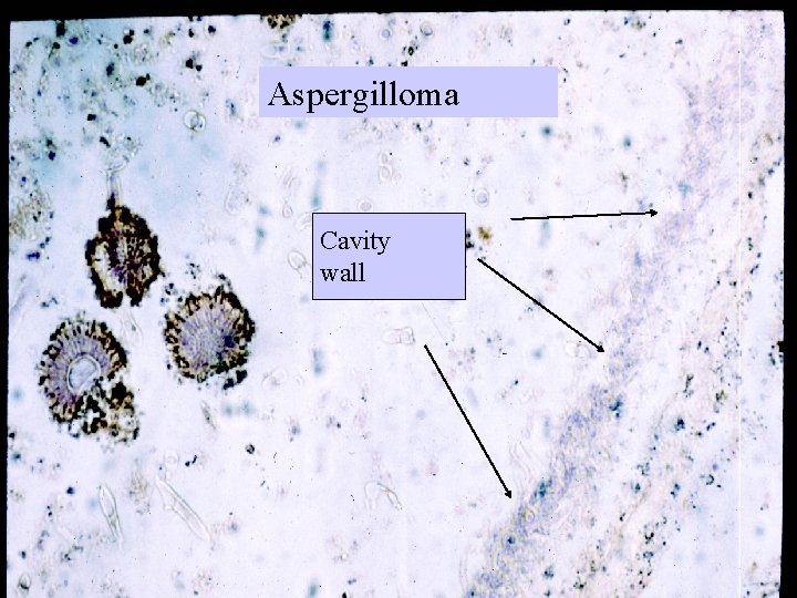 Aspergilloma Cavity wall 