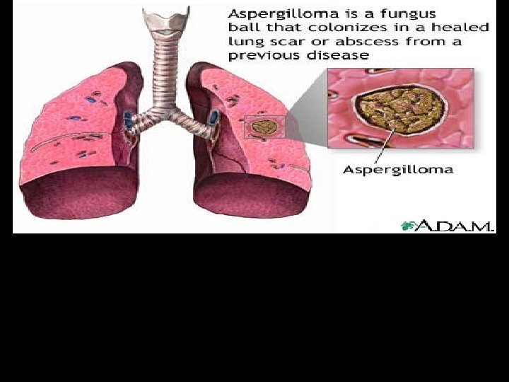 Verycommon: compost heaps, airbone dust�� Usuallyaffects the lungs and sinuses�� Less often: very agressive,