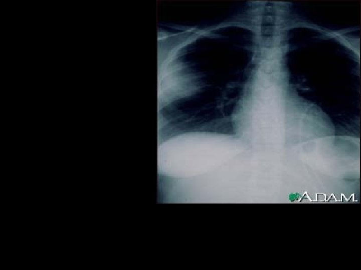 Aspergillosis– Symptoms& Diagnosis �� May cause no symptoms fungus ball Rx) Reapeted coughing up