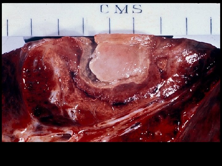 Aspergilloma found at post-mortem in the lung of a child with leukaemia. Note fungus